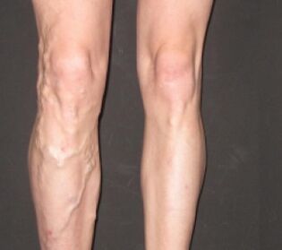 Téann varicosis chun cinn go tapa