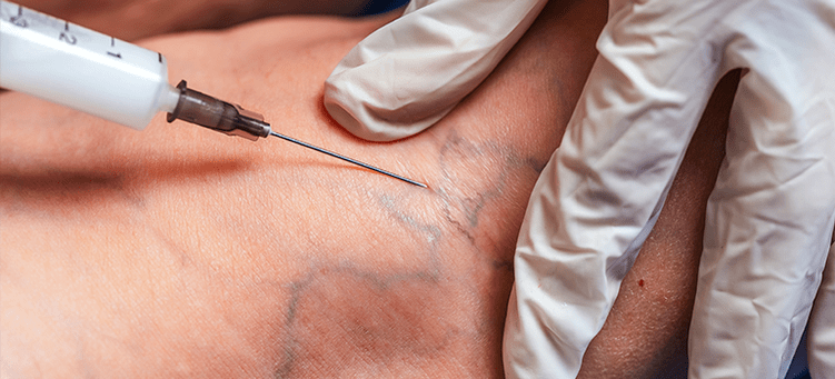 Is nós imeachta é sclerotherapy a chuireann deireadh le veins varicose