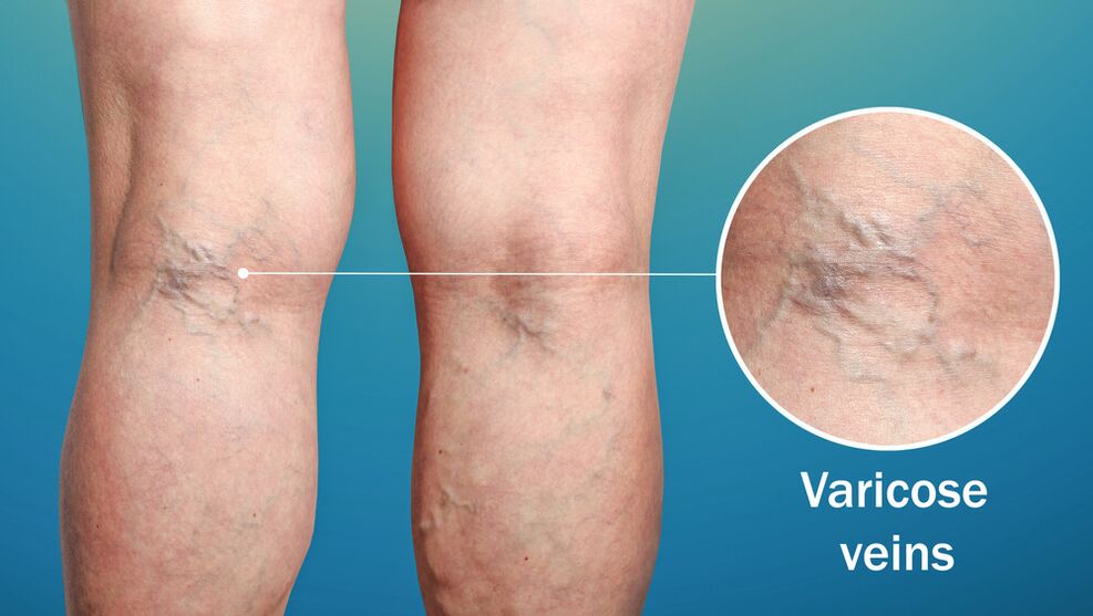 Veins varicose ar na cosa