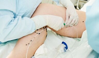 Modhanna chun féitheacha borrtha a chóireáil ar na cosa i measc na mban
