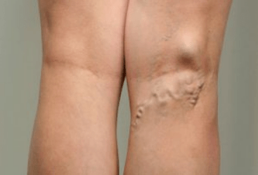 Diagnóis de veins varicose i mná torracha