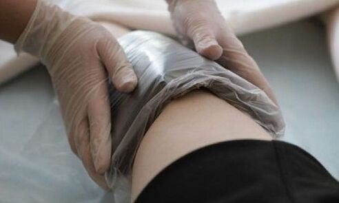 cóireáil veins varicose le compresses