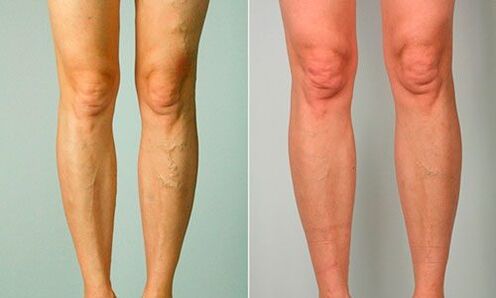 roimh agus tar éis cóireála le haghaidh veins varicose
