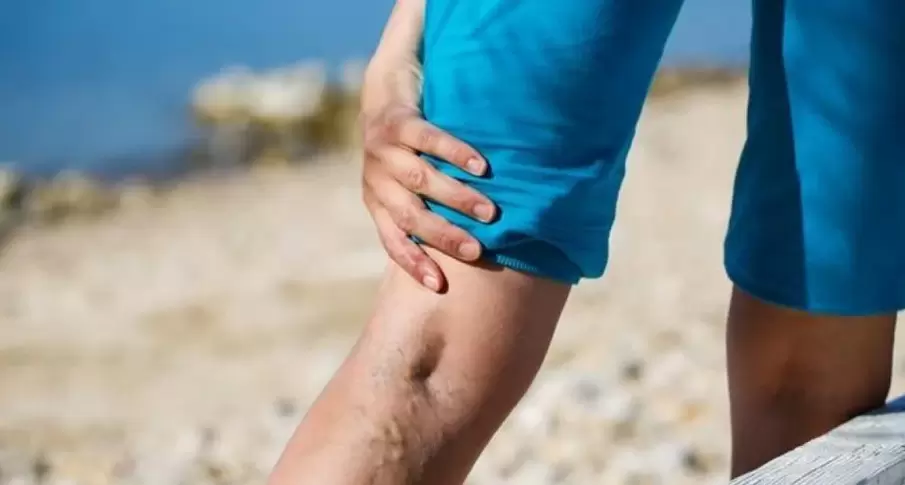 veins varicose ar na cosa