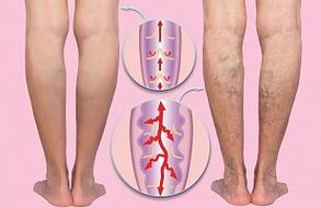 veins varicose de na foircinní níos ísle