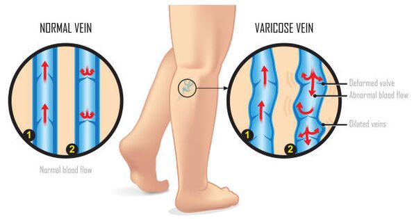 veins varicose de na foircinní níos ísle
