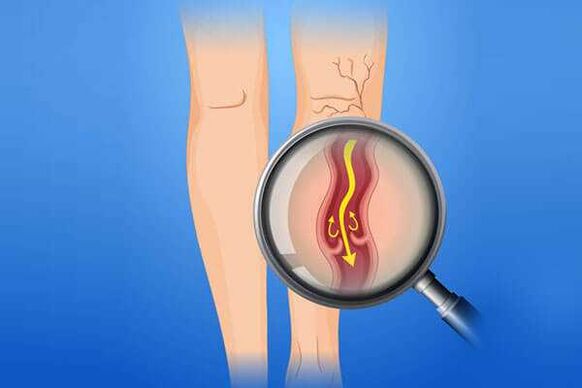 Comhla venous tionchar ag veins varicose