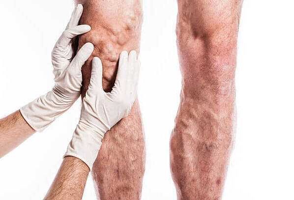 Palpation veins varicose ar na cosa