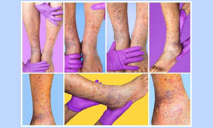 Scrúdaíonn phlebologist foircinní níos ísle othar le veins varicose