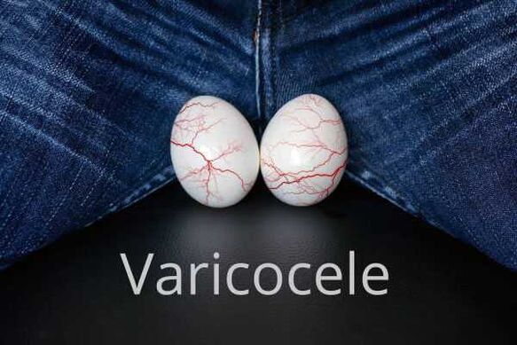Varicocele - caolú veins an chorda spermatic